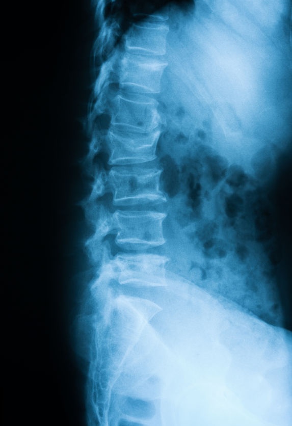 frattura avvallata del piatto superiore della prima vertebra lombare 