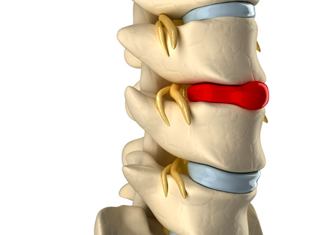 Come-migliorare-lernia-del-disco-con-la-ginnastica-posturale