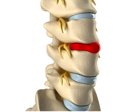 Come-migliorare-lernia-del-disco-con-la-ginnastica-posturale
